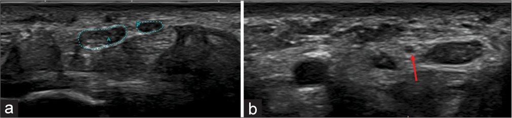 (a) Transverse axis ultrasound image showing bifid median nerve, outlined by green dots and (b) in a different patient, the persistent median artery (red arrow) is seen between the bifid median nerves.