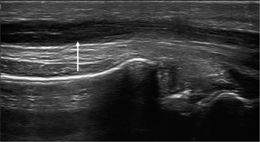 Longitudinal axis ultrasound image in a patient with leprosy showing an enlarged median nerve with thickened hypoechoic fascicles (white arrow).