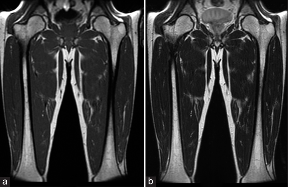 A 48-year-old male. (a) Coronal T1-weighted and (b) T2-weighted images demonstrate scattered areas of slight hypointensity involving bilateral femoral medullary cavities. Bone marrow burden score 3: T1: 1, T2: 1, Site: 1.