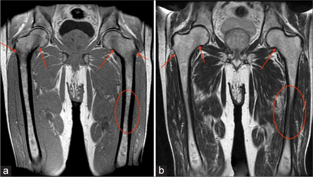 A 58-year-old male. (a) Coronal T1-weighted and (b) T2-weighted images demonstrate slight hypointensity of the bilateral femoral necks/diaphyses (ovals), as well as, the intertrochanteric regions and greater trochanters (arrows). Bone marrow burden score 4: T1: 2, T2: 1, Site: 2.