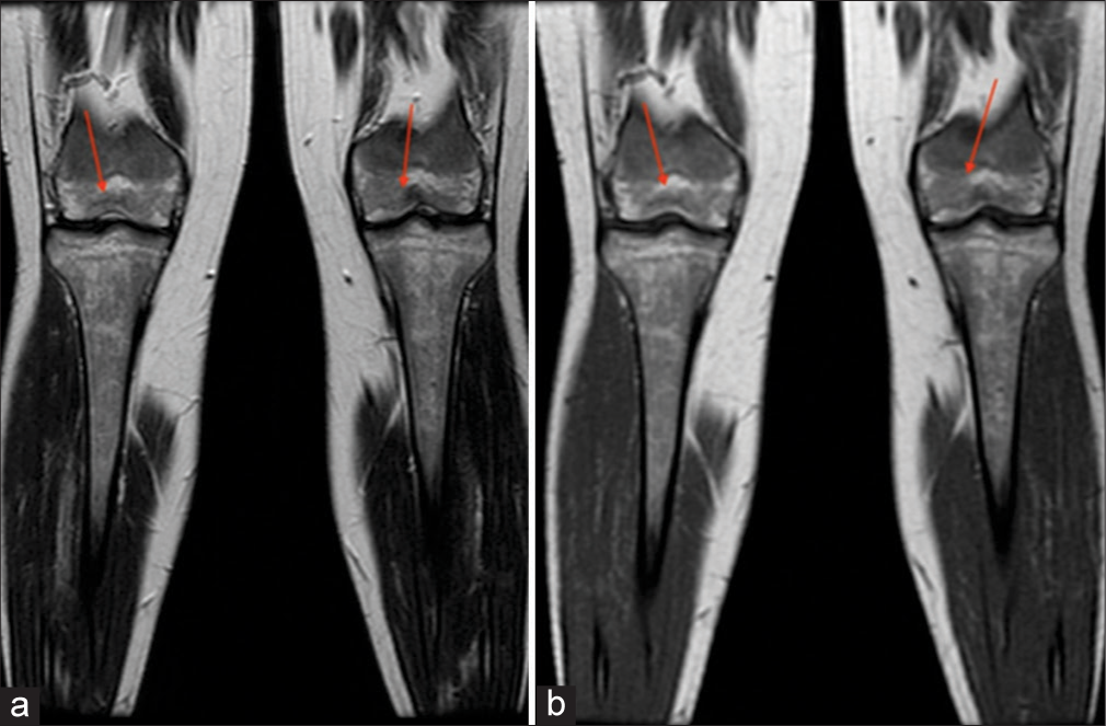 A 30-year -old female. (a) Coronal T1-weighted and (b) T2-weighted images demonstrate hypointensity of bilateral distal femoral epiphyses (arrows). Bone marrow burden score 7: T1: 2, T2: 2, Site: 3.