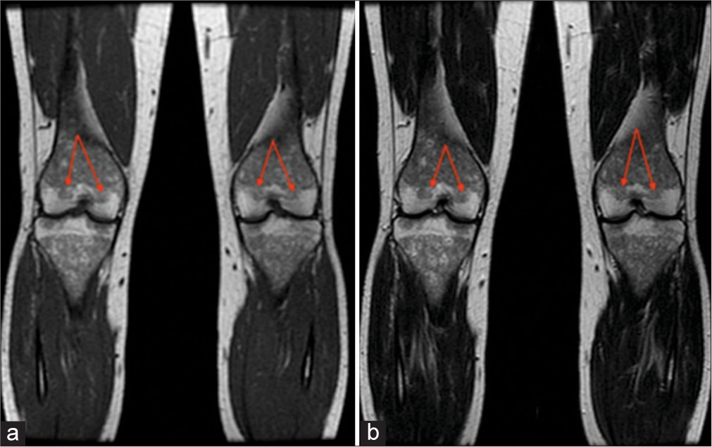 A 41-year-old female. (a) Coronal T1-weighted and (b) T2-weighted images demonstrate hypointensity of bilateral distal femoral epiphyses (arrows). Bone marrow burden score 7: T1: 2, T2: 2, Site: 3.