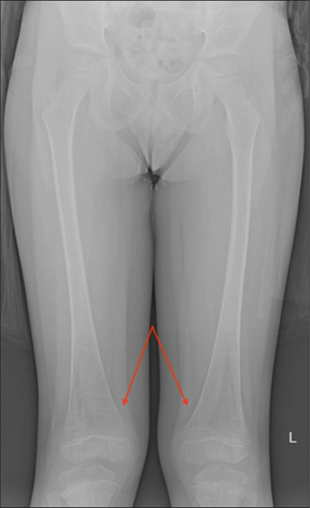 Erlenmeyer flask deformity. A 6-year-old male. AP radiograph of the bilateral femurs demonstrates the Erlenmeyer flask deformity (arrows) which results from undertubulation of the distal meta-diaphysis of the distal femur and implies bone marrow involvement in children with Gaucher’s disease.