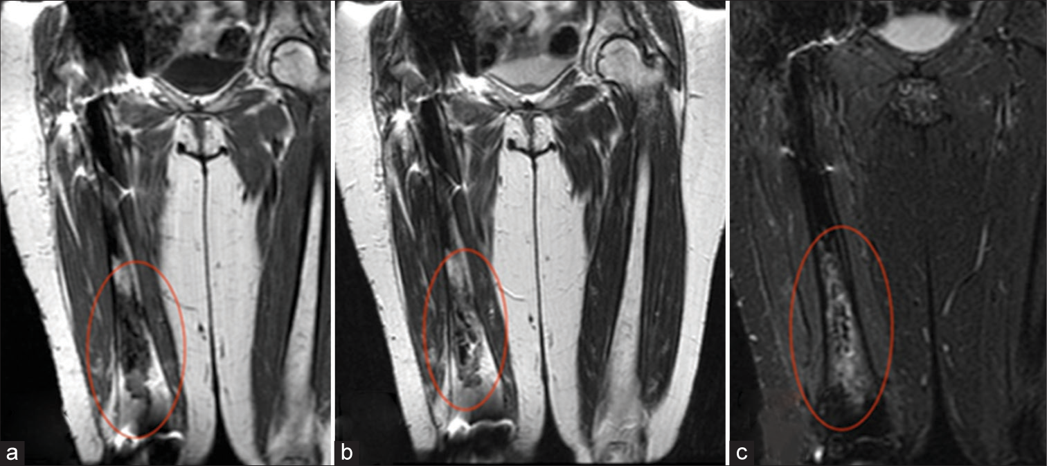 Osteonecrosis. A 37-year-old female. (a) Coronal T1-weighted and (b) T2-weighted images demonstrate hypointensity of the right distal femoral diaphysis (ovals), corresponding to fibrosed and sclerosed bone marrow of chronic infarcted bone. (c) Coronal Short Tau Inversion Recovery (STIR) image demonstrates surrounding hyperintensity corresponding to reactive bone marrow edema and a serpiginous rim of hyperintensity representing granulation tissue (oval).