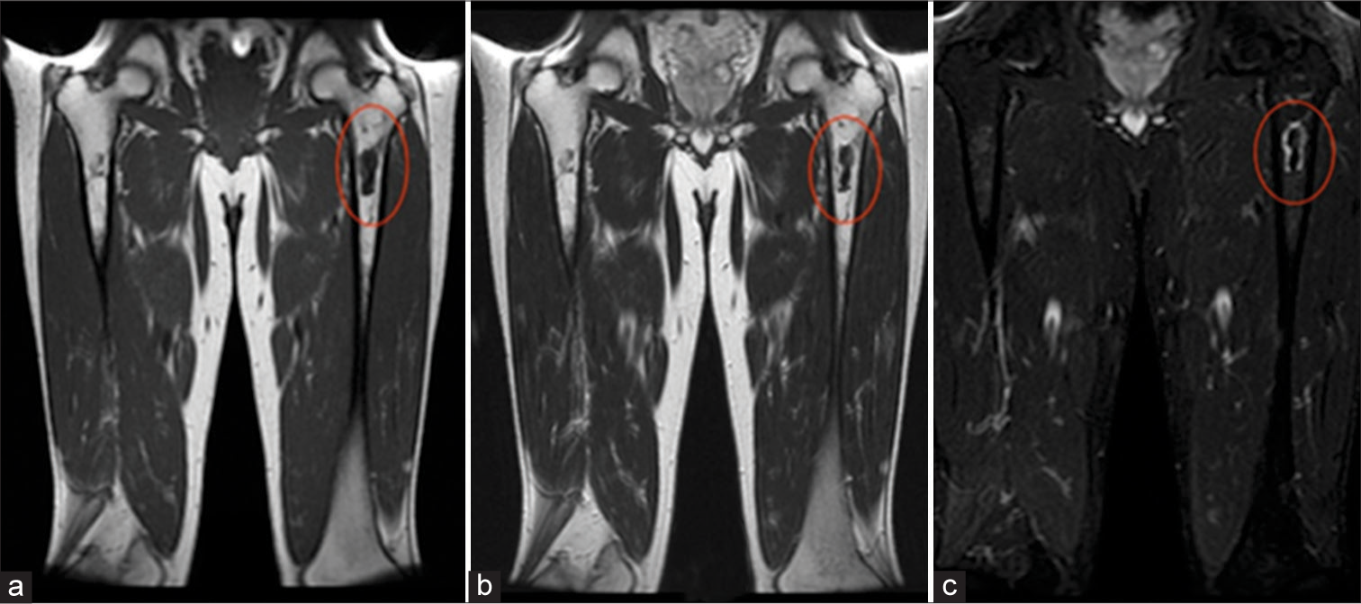 Osteonecrosis. A 55-year-old male. (a) Coronal T1-weighted and (b) T2-weighted images demonstrate hypointensity of the left proximal femoral diaphysis (ovals), corresponding to fibrosed and sclerosed bone marrow of chronic infarcted bone. (c) Coronal Short Tau Inversion Recovery (STIR) image demonstrates serpiginous outer rim of hypointensity demarcating the border between living and necrotic bone, as well as, inner rim of hyperintensity representing granulation tissue (oval).
