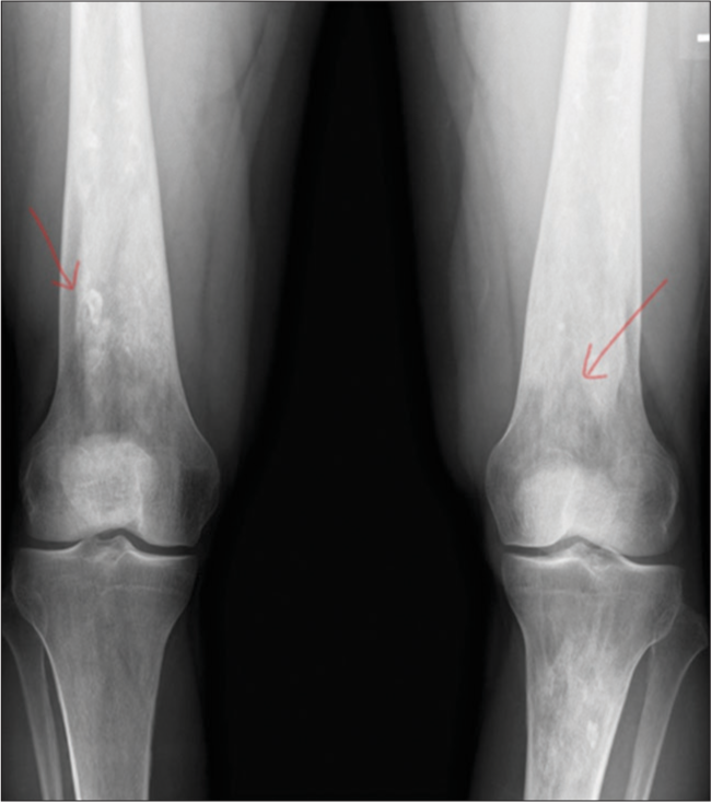 Osteonecrosis. A 40-year-old male. AP radiograph of the bilateral femurs demonstrates serpiginous sclerosis (arrows) in the distal femurs, consistent with osteonecrosis in this patient with Gaucher’s disease.