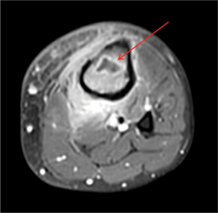 Intraosseous abscess. A 26-year-old male. An axial T1-weighted post-contrast image demonstrating an intraosseous abscess (arrow). Hyperintense signal is noted within the surrounding subcutaneous tissue representing reactive subcutaneous edema and hyperemia.