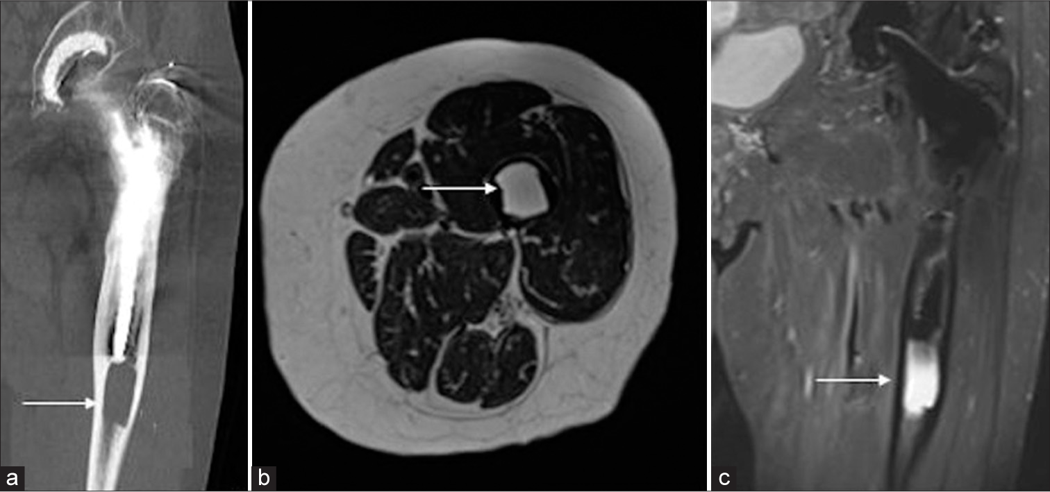 (a) Computed tomography coronal (white arrow) and (b) magnetic resonance imaging axial T2 (white arrow) and (c) coronal T2 FS sequences demonstrating the lytic lesion (white arrow).