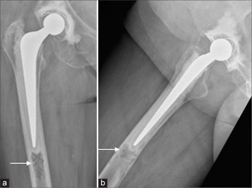 Anteroposterior (a) (white arrow) and lateral (b) radiographs of the right hip performed at presentation 13 years post-total hip replacement demonstrating a lytic lesion in the femur adjacent to the tip of the femoral prosthetic stem (white arrow).