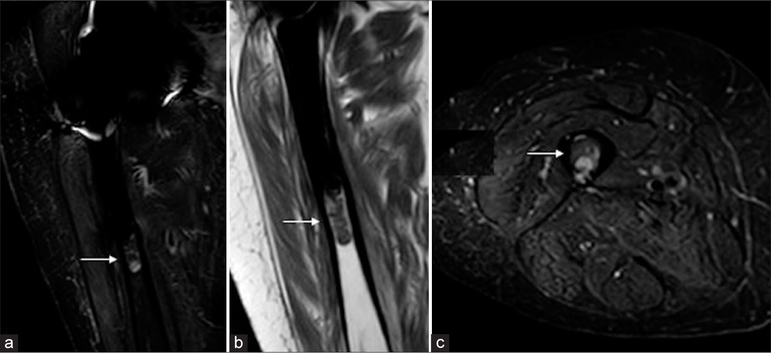 (a) Coronal proton density fat saturation (white arrow), (b) coronal T1 (white arrow), and (c) axial proton density fat saturation (PDFS) weighted images obtained at the time of presentation showing abnormality distal to the femoral prosthesis (white arrow).