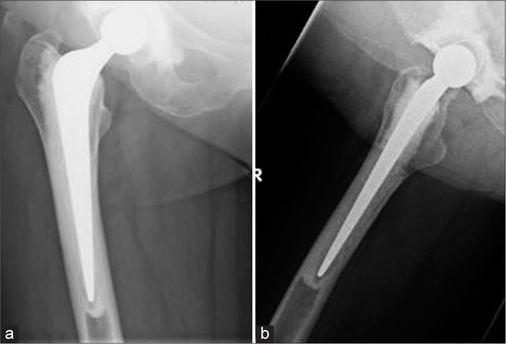 (a and b) Anteroposterior and lateral views of the right hip performed immediately after the right total hip replacement as part of routine follow-up. Note the absence of the lytic lesion on these radiographs.