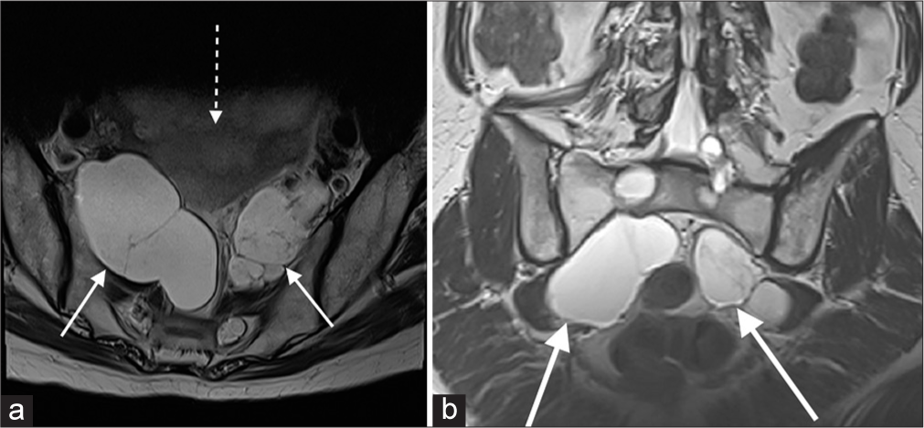 (a and b) T2-weighted imaging demonstrating bilateral sacral Tarlov cysts (solid white arrows), either side of the uterus (dotted arrow), accounting for the sonographic findings.