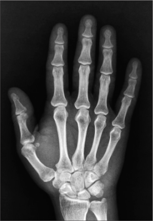 Plain radiograph (dorsovolar view) of the right wrist showing normal osseous and articular structures.