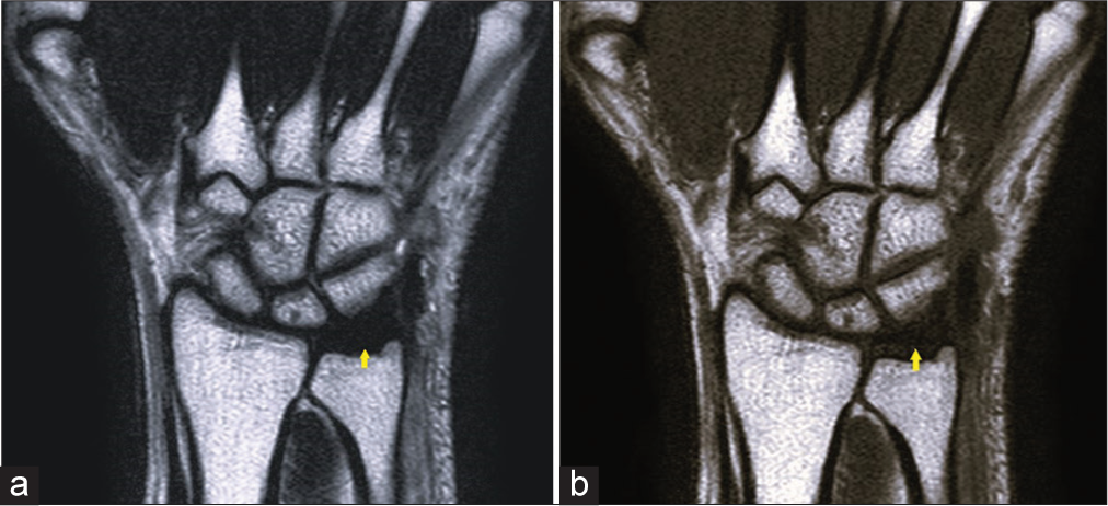 (a) Coronal T2-weighted magnetic resonance (MR) images of the wrist demonstrate normal hypointense signal of the triangular fibrocartilage complex (TFCC) (yellow arrow). (b) Coronal T1-weighted MR images of the wrist demonstrate a normal hypointense signal of the TFCC (yellow arrow).