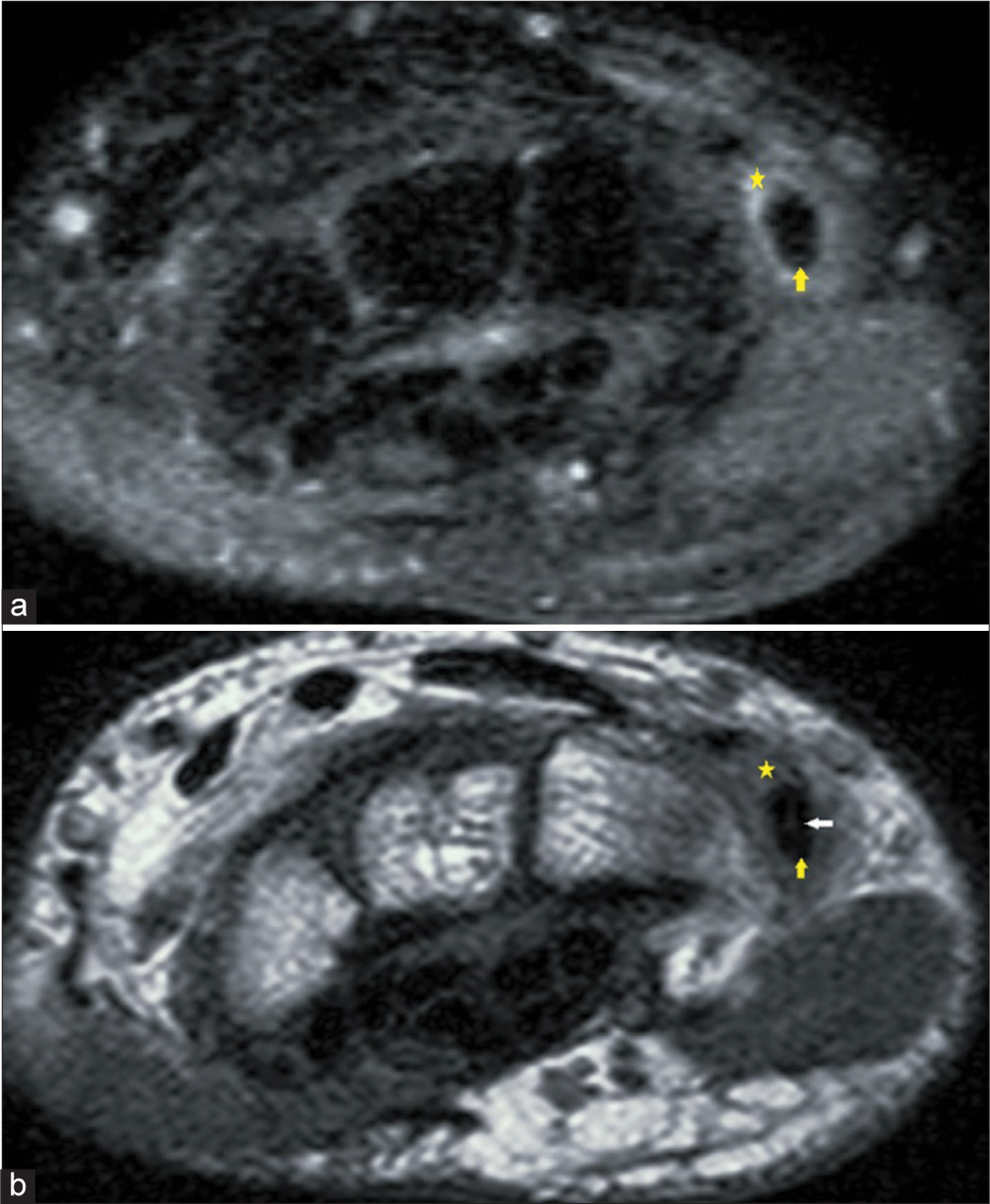 (a) Axial proton density (PD) fat-saturated magnetic resonance (MR) images of the wrist demonstrate synovial thickening with fluid in the tendon sheath of extensor carpi ulnaris (ECU) (yellow asterisk). ECU tendon (yellow arrow) demonstrates normal signal intensity. (b) T1-weighted MR images of the wrist demonstrate synovial thickening with fluid in the tendon sheath of ECU (yellow asterisk). ECU tendon (yellow arrow) demonstrates normal low-signal intensity peripherally. A small T1 isointense focus is seen within the substance of the ECU tendon (white arrow), suggesting a chronic partially healed tear.