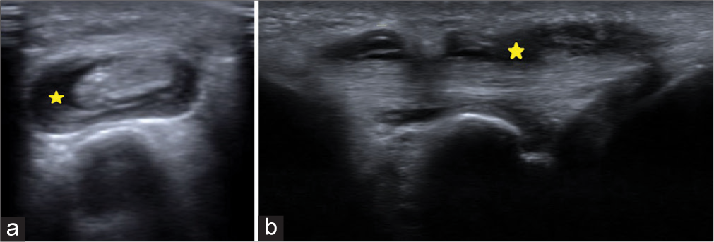 (a) Ultrasound short-axis images of the wrist demonstrate synovial thickening with fluid in the tendon sheath of extensor carpi ulnaris (ECU) (yellow asterisk), consistent with ECU tenosynovitis. (b) Ultrasound long-axis images of the wrist demonstrate synovial thickening with fluid in the tendon sheath of ECU (yellow asterisk), consistent with ECU tenosynovitis.