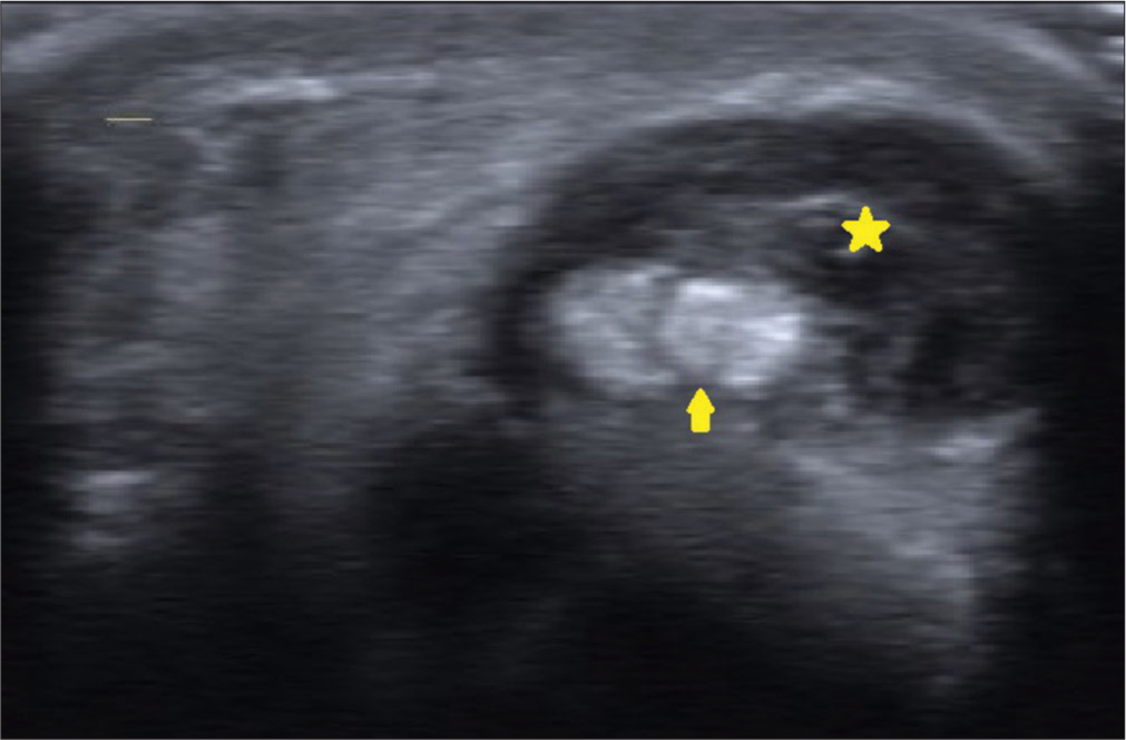 Ultrasound of the short axis of the wrist demonstrates a full-thickness split tear of the extensor carpi ulnaris tendon (yellow arrow) with surrounding tenosynovitis (yellow asterisk).