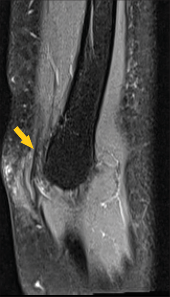 Fat-suppressed proton-density-weighted turbo spin-echo sagittal section showing ulnar nerve (arrow) with bright signal intensities. Note that the ulnar nerve is thickened and edematous within the cubital tunnel.