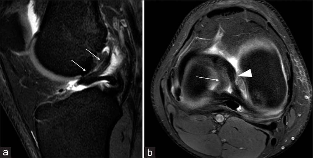 (a and b) Sagittal proton-density fat-suppressed (PDFS) (a) and axial PDFS (b) sequences of the right knee. The hypertrophied lateral oblique inter meniscal ligament is well demonstrated in the sagittal image (a, white arrows). Axial image (b) demonstrating the attachment of the lateral oblique intermeniscal ligament to the anterior horn of the lateral meniscus and posterior horn of the medial meniscus (white arrowhead) and the ring-shaped morphology of the lateral meniscus (white arrow).