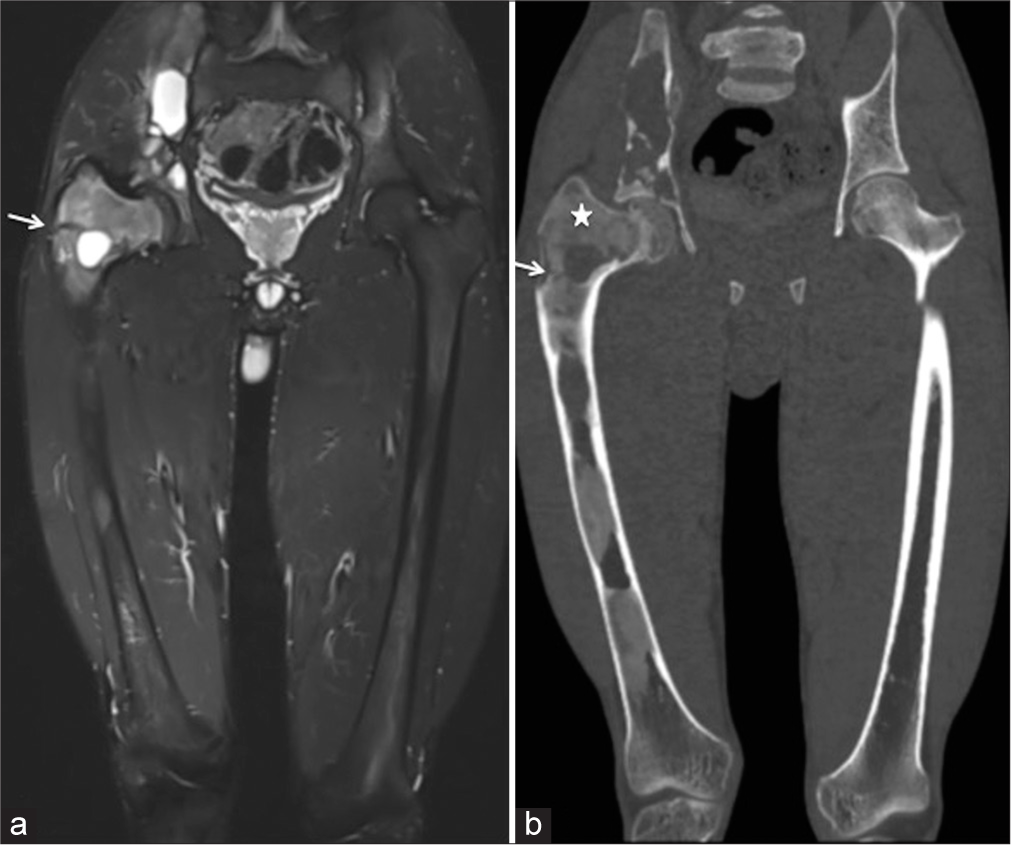 (a) Coronal PDFS magnetic resonance imaging of hip joints, femur, and proximal knee joints showed the extent of involvement of the right innominate bone and right femur. A hypointense line was seen in the neck of the femur (solid white arrow), suspicious of fracture. (b) Corresponding coronal maximum intensity projection (MIP) computed tomography scan image (b) showed the classical ground glass matrix of fibrous dysplasia (star) and interspersed lytic lesions. A hypodense minimally displaced fracture line was seen in the neck of the femur (White arrow).