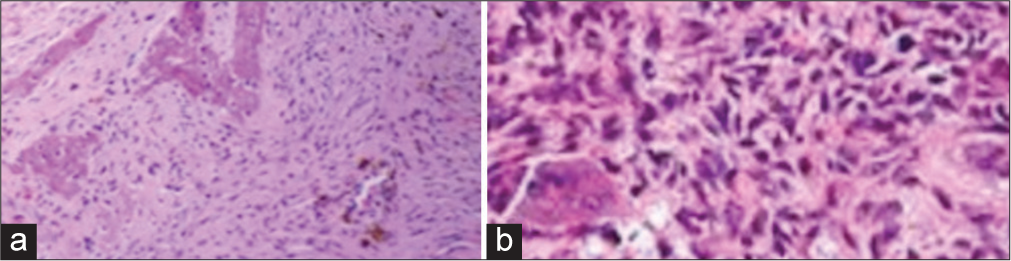 (a and b) Histopathology images show (a) the presence of osseous trabeculae in the background of fibrous changes and (b) vascular endothelial channels.