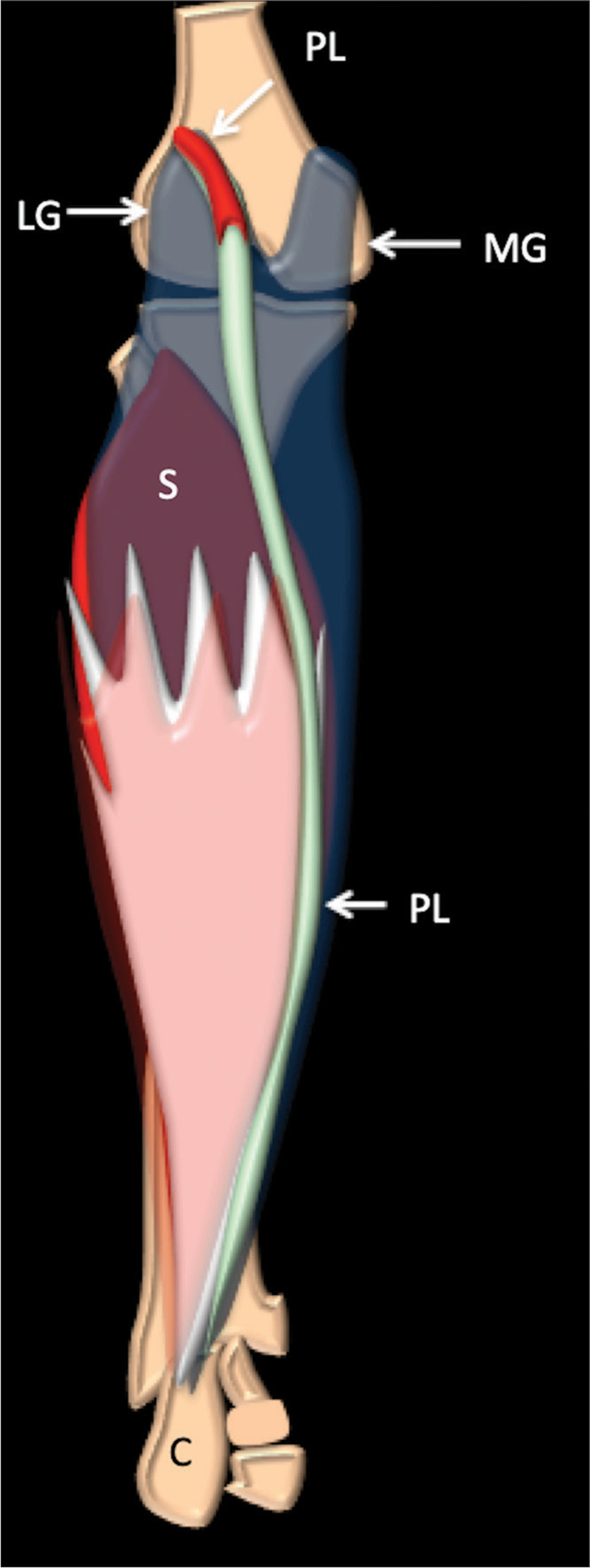 Schematic anatomy plantaris muscle, tendon, and relationships in the back of the calf. (MG: Medial gastrocnemius, LG: Lateral gastrocnemius, S: Soleus , C- calcaneum, and PL- plantaris).