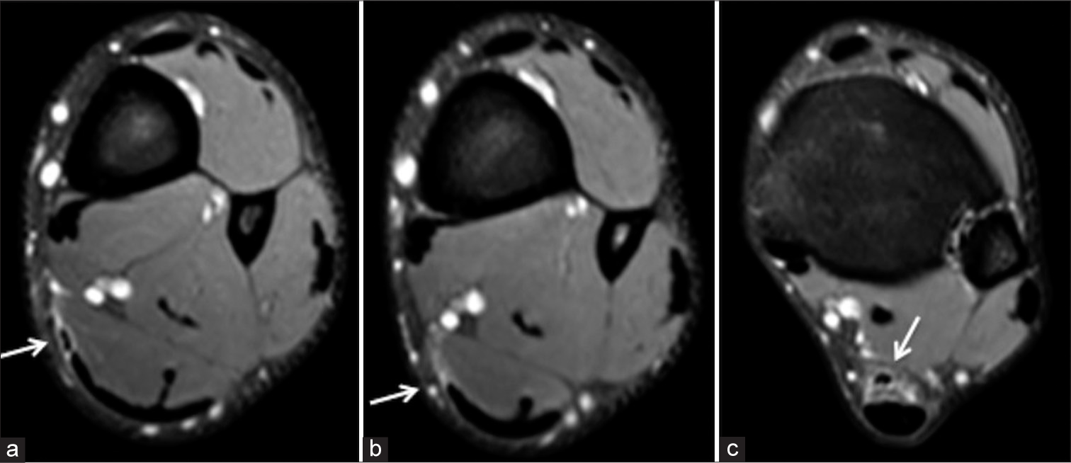 (a-c) Proton density fat-saturated (PDFS) axials at the levels shown - demonstrate fluid in relation to the (a,c) distal plantaris (arrow) and (b) full thickness tear of plantaris (arrow).