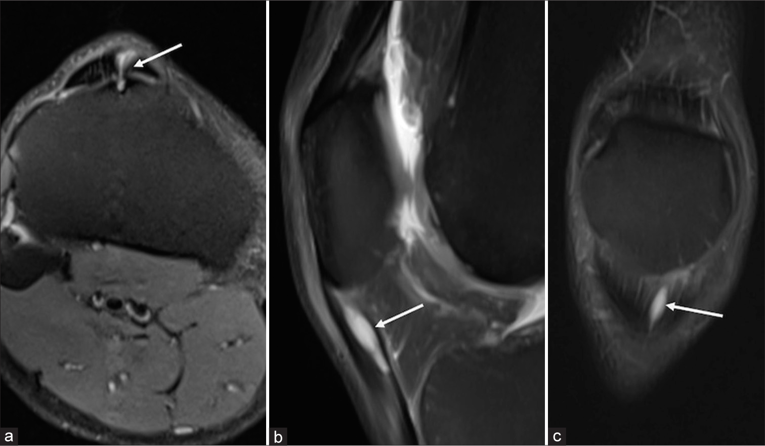 (a) Axial, (b) sagittal, and (c) coronal proton-density fat-saturated (PDFS) images of magnetic resonance imaging knee at the level of cyst show a well-defined PDFS fluid intensity oval-shaped lesion noted just distal to the inferior pole of the patella in the patellar tendon (White arrow). The cyst has caused mild local expansion of the patellar tendon, resulting in a focal fusiform enlargement. Note the partial tear of a few fibers of the patellar tendon (White arrow).