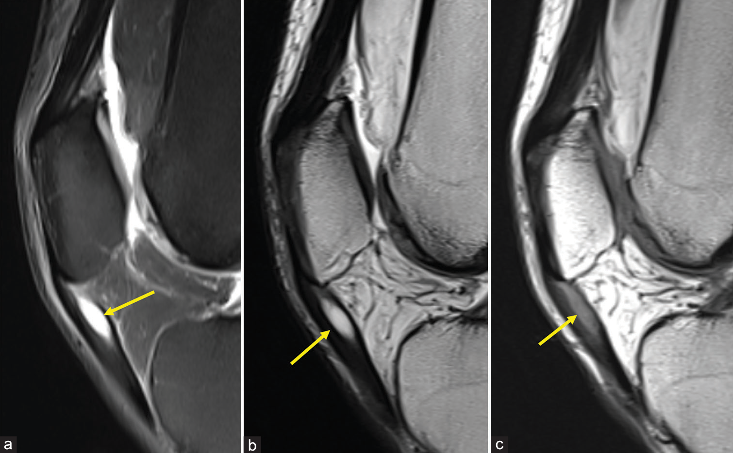 A well-defined (a) Hyperintense on proton-density fat-saturated and (b) T2, (c) Hypointense on T1 oval Shaped lesion noted just distal to the inferior pole of patella in the patellar tendon (Yellow arrow). The cyst has caused mild local expansion of the patellar tendon, resulting in a focal fusiform enlargement. Note the partial tear of a few fibres of the patellar tendon (Yellow arrow).