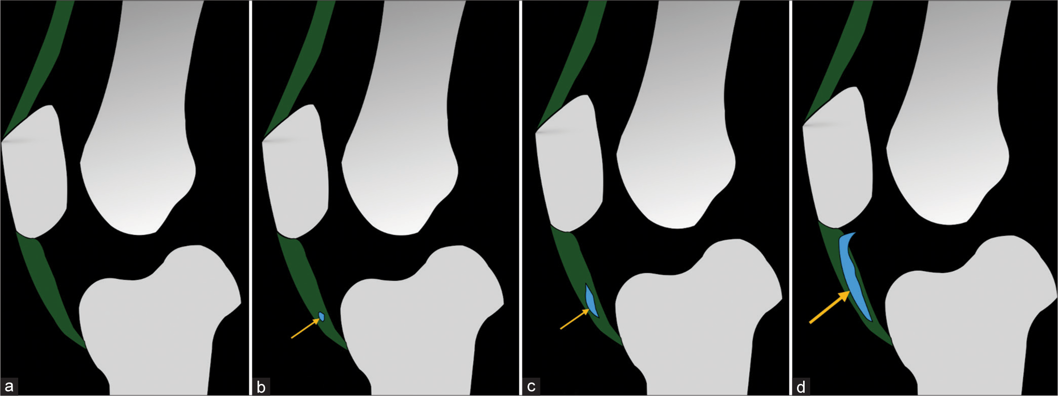 A series of illustrations. Image (a) depicts a healthy patellar tendon. Images (b-d) collectively demonstrate the potential gradual development of an intratendinous ganglion cyst within the patellar tendon (Yellow arrow).