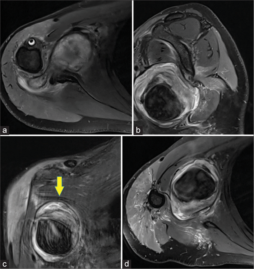 Multiplanar proton density fat saturation images - (a and d) axial, (b) sagittal, (c) coronal, depicting large peripheral partially thrombosed pseudoaneurysm (Yellow arrow in c) in the intermuscular axillary space. However, no definite vascular feeding neck could be demonstrated on magnetic resonance imaging.