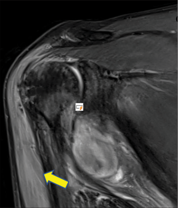 Coronal proton density fat saturation images showing hyperintense signal within the bulk of deltoid (Arrow) muscle hinting at traumatic axillary neuropathy due to quadrilateral space syndrome.