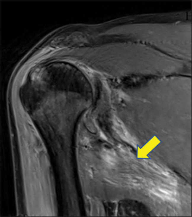 Coronal proton density fat saturation images showing hyperintense signal within the bulk of teres minor (arrow) muscle hinting at traumatic axillary neuropathy due to quadrilateral space syndrome.