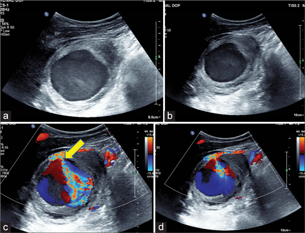 (a and b) Screening ultrasound B-mode and (c and d) Doppler images of the right shoulder region depicting a peripherally thrombosed pulsatile pseudoaneurysm with luminal Yin-Yang sign (c and d) within the axillary space and a demonstrable thin vascular communication (yellow arrow in 6c) with the right axillary artery.