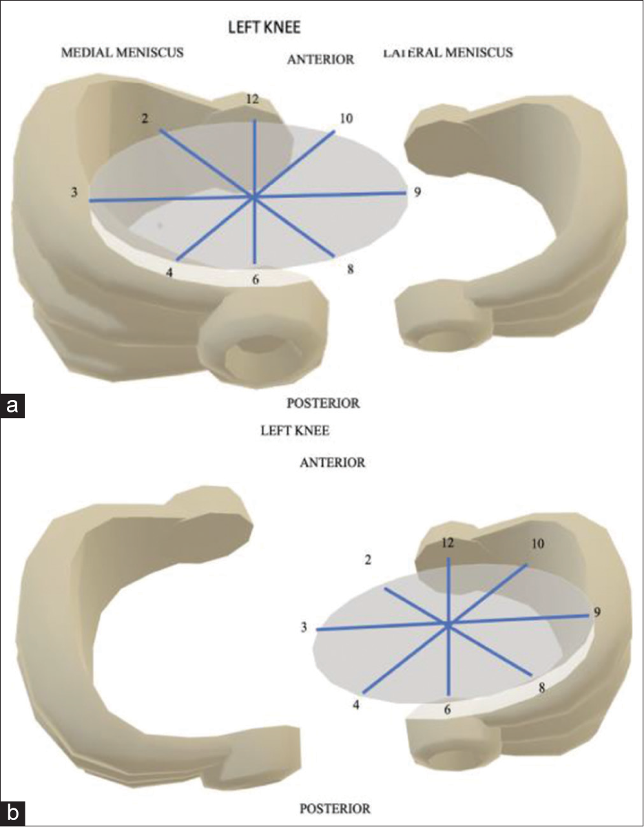 (a) Pictorial representation of the clock position in the medial meniscus of the left knee. (b) Pictorial representation of the clock position in the lateral meniscus of the left knee.