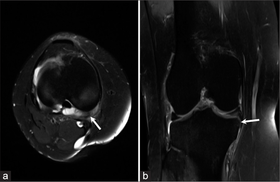 (a) Axial proton density fat saturated (PDFS) image of a 35 years old patient with a history of trauma to the right knee shows a displaced medial meniscal fragment (arrow) arising from its posterior horn and body at 5 o’clock position. (b) Coronal proton density fat saturated (PDFS) image of the same patient shows the displaced fragment in the inferior coronary recess (horizontal arrow).