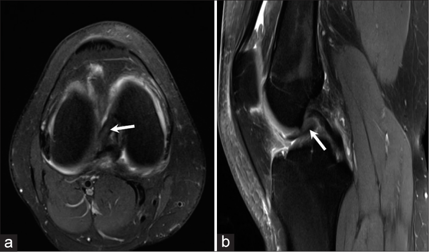 (a) Axial proton density fat saturated (PDFS) image of a 39 years old patient with a history of trauma shows a displaced meniscal fragment arising from the anterior horn and body of medial meniscus at 9 o’clock position (arrow). (b) Sagittal proton density fat saturated (PDFS) image of the same patient shows the displaced medial meniscal fragment in the intercondylar region (arrow).