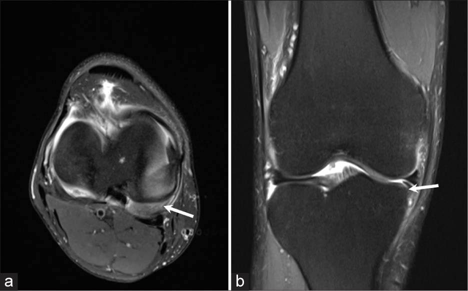 (a) Axial proton density fat saturated (PDFS) image of a 45 years old patient with a history of pain in the medial aspect of right knee joint shows a displaced fragment arising from the body and posterior horn of medial meniscus at 4 o’clock position (arrow). (b) Coronal proton density fat saturated (PDFS) image of the same patient showing the displaced fragment inferior to the medial meniscus (‘Boomerang sign’) (arrow).