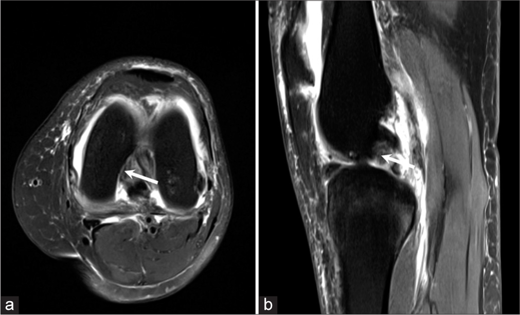 (a) Axial proton density fat saturated (PDFS) image of a 43 years old patient with a history of trauma to the left knee shows a displaced macerated medial meniscal fragment at 9-10 o’clock position (arrow). (b) Sagittal proton density fat saturated (PDFS) image of the same patient shows the displaced meniscal fragment anterior to the posterior cruciate ligament (PCL) (arrow).