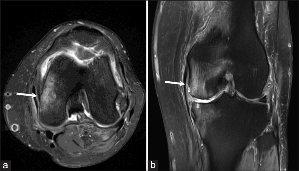 (a) Axial proton density fat saturated (PDFS) image of a 40 years old patient with a history of fall shows the displaced medial meniscal fragment at 3 o’clock position in the left knee (arrow). (b) Coronal proton density fat saturated (PDFS) image of the same patient shows the displaced medial meniscal fragment in the superior coronary recess (arrow).