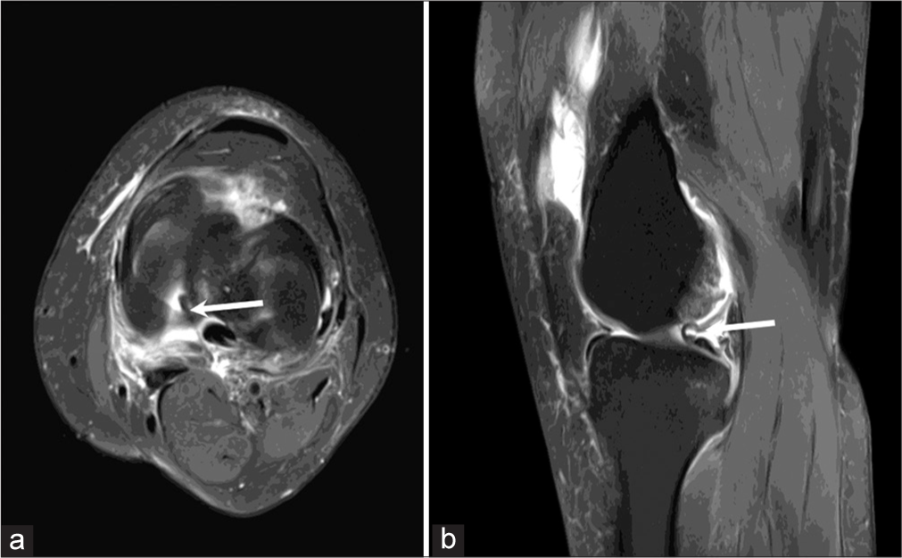 (a) Axial proton density fat saturated (PDFS) image of 35 years patient with a history of accident shows the displaced lateral meniscal fragment lying medially at 7 o’clock position in the left knee (arrow). (b) Sagittal proton density fat saturated (PDFS) image of the same patient shows the displaced medial meniscal fragment lying in the posterior intercondylar region (arrow).