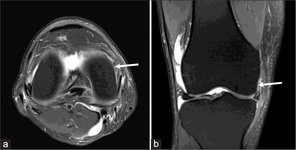 (a) Axial proton density fat saturated (PDFS) image of a 47 year old patient with a history of pain in the right knee shows a displaced fragment arising from the posterior horn of medial meniscus at 2 o’clock position (arrow). (b) Coronal proton density fat saturated (PDFS) image of the same patient shows the displaced fragment in the superior coronary recess (arrow).