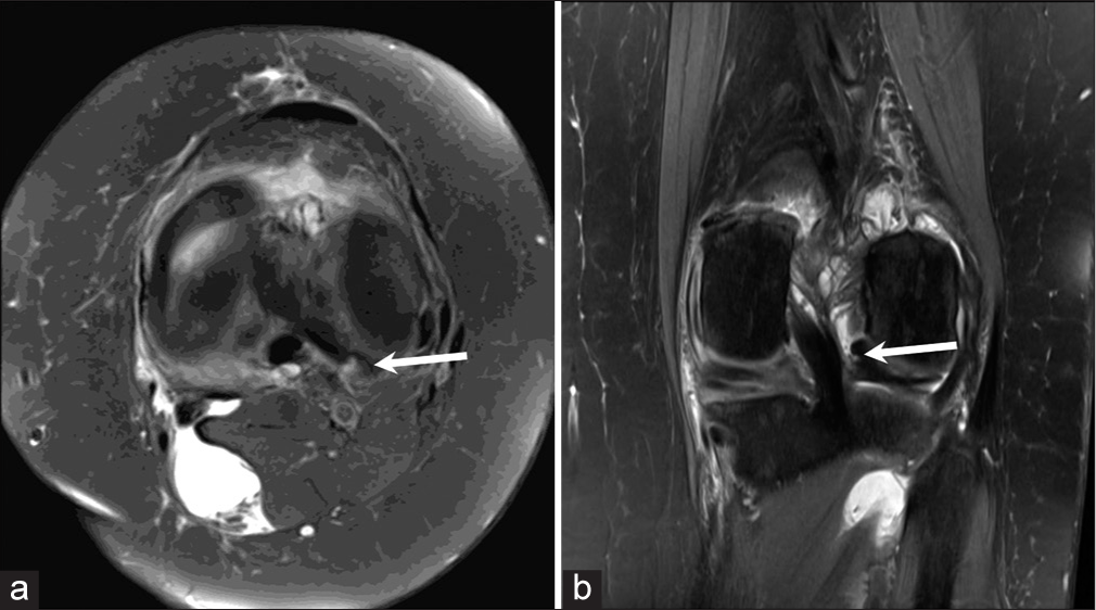 (a) Axial proton density fat saturated (PDFS) image of a 34 years old patient with a history of sports injury to the left knee shows a displaced fragment arising from the posterior horn and body of the lateral meniscus at 5 o’clock position (arrow). (b) Coronal proton density fat saturated (PDFS) image of the same patient shows the displaced lateral meniscal fragment in the intercondylar region (arrow).