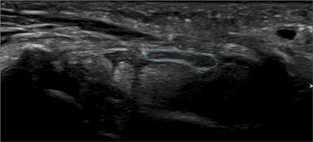 Transverse axis ultrasound image showing measurement of the cross section area of the median nerve (A) distal to the outlet of the carpal tunnel (Green dots).