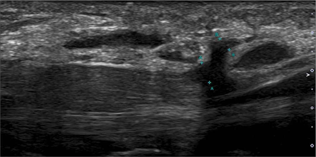 Longitudinal axis ultrasound image showing the thickened and hypoechoic recurrent motor branch of median nerve (indicated by green calipers) in a patient with neuropathy. The median nerve is also grossly thickened.