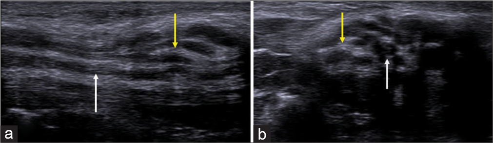 (a) Longitudinal axis and (b) transverse axis ultrasound images in a patient with fibrolipomatous hamartoma of the median nerve showing the enlarged nerve with thickened hypoechoic fascicles (white arrows) surrounded by echogenic fat (yellow arrows).