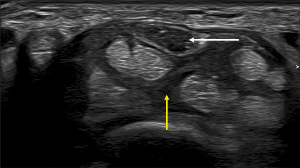 Transverse axis ultrasound image showing median neuropathy (white arrow) due to flexor tenosynovitis (yellow arrow).