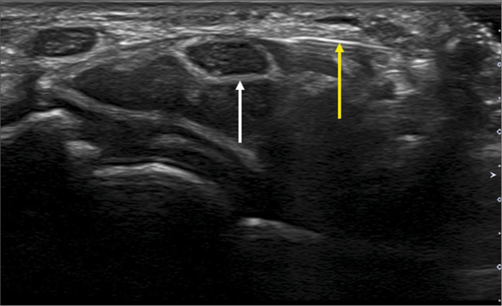 Transverse axis ultrasound image showing hydrodissection needle (yellow arrow) in a case of median neuropathy (white arrow).