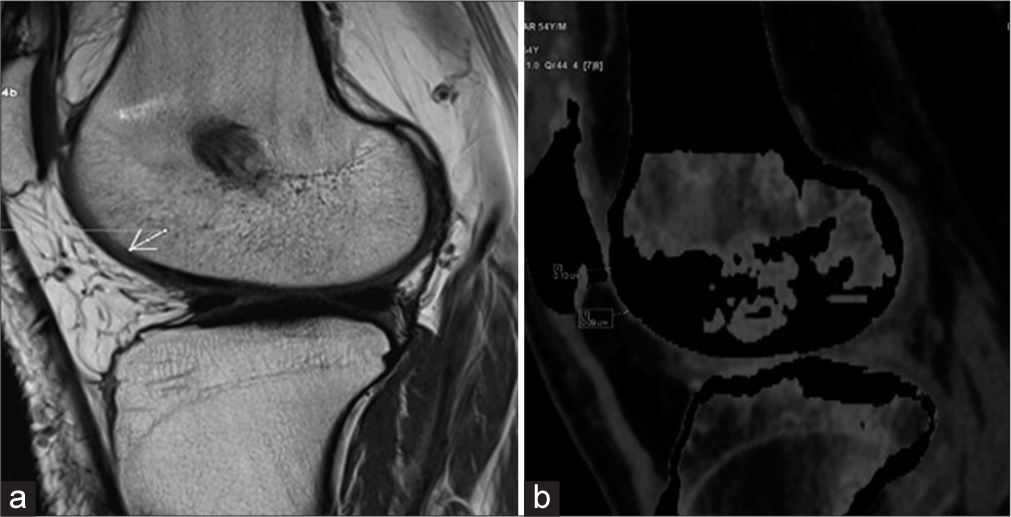 (a) Proton density sagittal magnetic resonance image showing the patellofemoral cartilage. (b) Sagittal dual-energy computed tomography with calcium suppression technique image shows patellofemoral cartilage. The arrow indicates Areas of cartilage thinning is consistent with degenerative changes observed in osteoarthritic conditions.