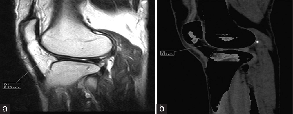 (a) Proton density sagittal magnetic resonance image shows lateral femoral tibial cartilage thickness. (b) Sagittal dual-energy computed tomography with calcium suppression technique image shows lateral femoral tibial cartilage thickness.